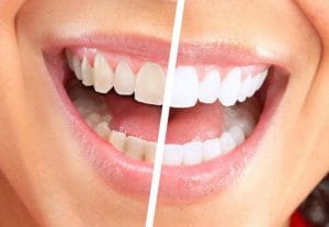 Read more about the article Albirea dentara daunatoare – Tipuri de albire, contraindicatii si efecte adverse