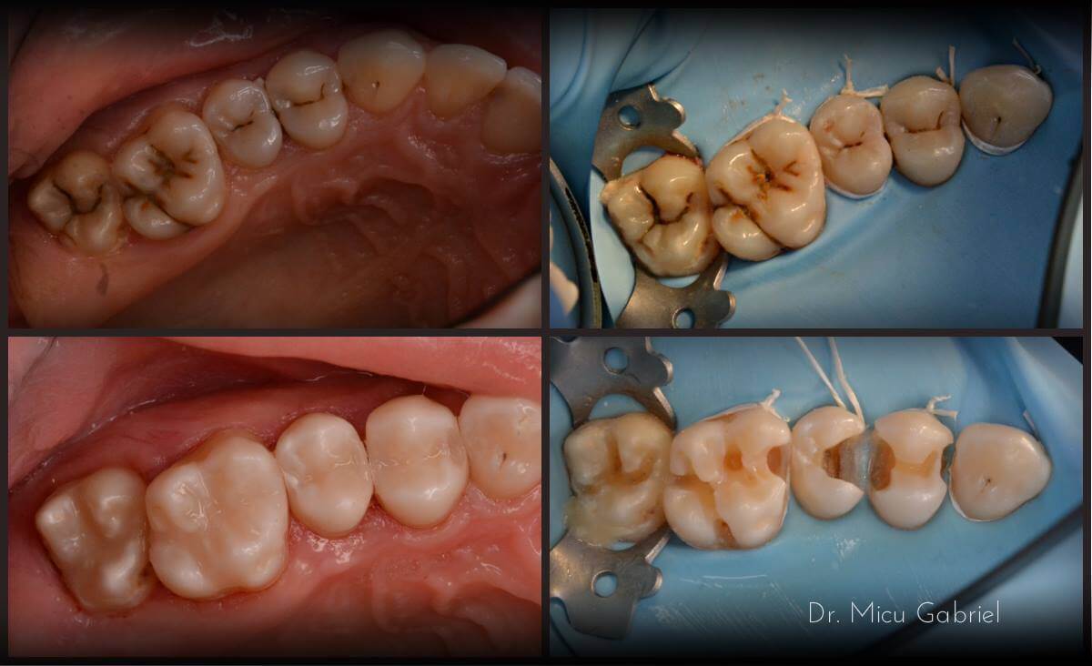 You are currently viewing Tratamentul SingleVisit, solutia perfecta pentru pacientii fara timp!