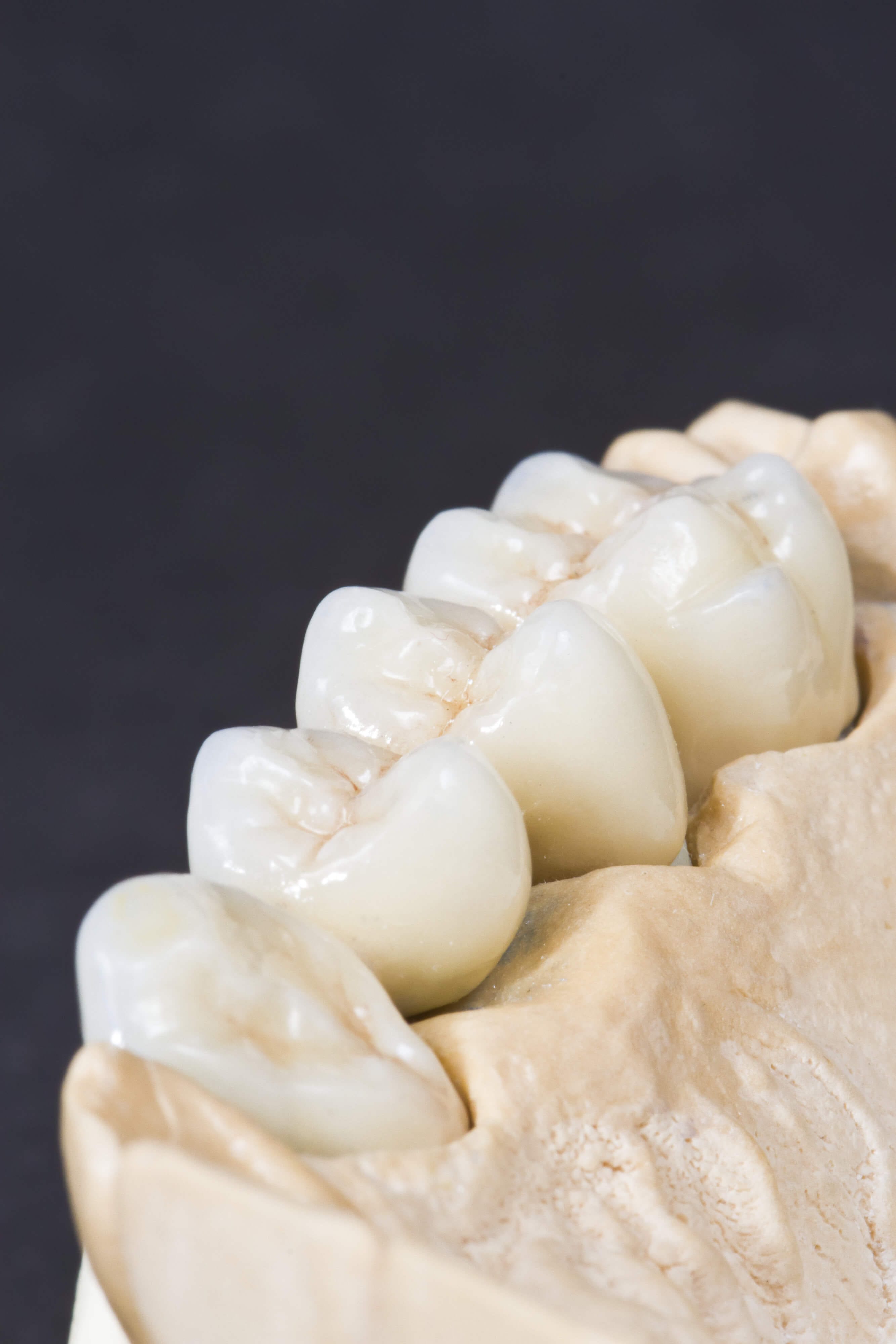 Read more about the article 8 motive pentru a alege zirconiu la realizarea unei lucrari dentare!