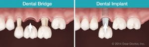 dental-bridge-vs-dental-implant (1)